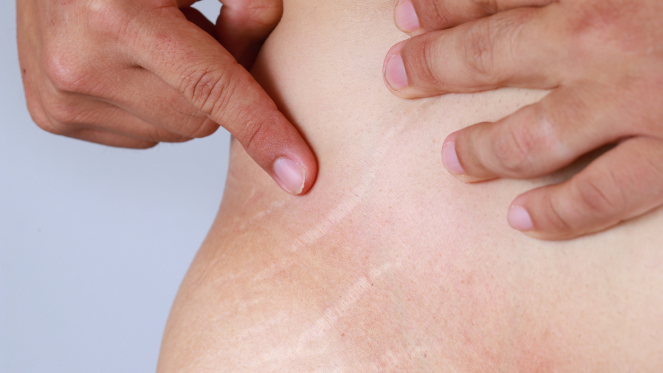 Hyperpigmentation (5)